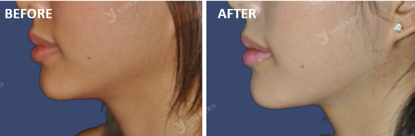 chin fillers[4].png (600×197)